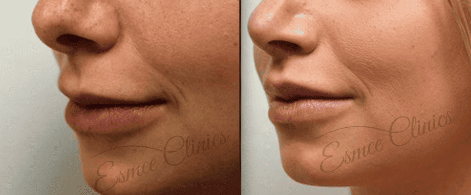 Before and After img